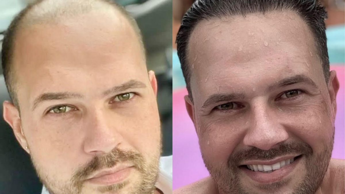 antes e depois transplante capilar - Grupo Capilar