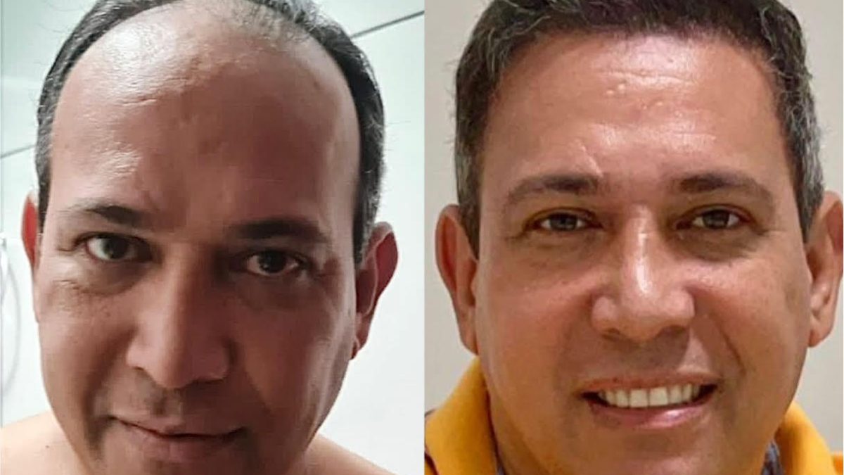 foto de resultado antes e depois de transplante capilar